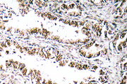 STEAP1 / STEAP Antibody - Immunohistochemistry analysis of STEAP1 antibody in paraffin-embedded human prostate carcinoma tissue.