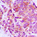 STEAP4 Antibody - Immunohistochemical analysis of STEAP4 staining in human prostate cancer formalin fixed paraffin embedded tissue section. The section was pre-treated using heat mediated antigen retrieval with sodium citrate buffer (pH 6.0). The section was then incubated with the antibody at room temperature and detected using an HRP conjugated compact polymer system. DAB was used as the chromogen. The section was then counterstained with hematoxylin and mounted with DPX.