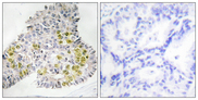 STK11 / LKB1 Antibody - Immunohistochemistry analysis of paraffin-embedded human lung carcinoma tissue, using LKB1 Antibody. The picture on the right is blocked with the synthesized peptide.