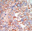 STK24 / MST3 Antibody - Formalin-fixed and paraffin-embedded human cancer tissue reacted with the primary antibody, which was peroxidase-conjugated to the secondary antibody, followed by AEC staining. This data demonstrates the use of this antibody for immunohistochemistry; clinical relevance has not been evaluated. BC = breast carcinoma; HC = hepatocarcinoma.