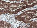 STK38L / NDR2 Antibody - IHC of paraffin-embedded Adenocarcinoma of Human ovary tissue using anti-STK38L mouse monoclonal antibody.