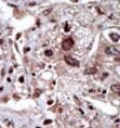 STK39 / SPAK Antibody - Formalin-fixed and paraffin-embedded human cancer tissue reacted with the primary antibody, which was peroxidase-conjugated to the secondary antibody, followed by DAB staining. This data demonstrates the use of this antibody for immunohistochemistry; clinical relevance has not been evaluated. BC = breast carcinoma; HC = hepatocarcinoma.