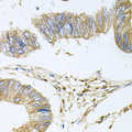 STRN3 Antibody - Immunohistochemistry of paraffin-embedded human colon carcinoma tissue.