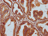 STT3B Antibody - Immunohistochemistry Dilution at 1:300 and staining in paraffin-embedded human prostate tissue performed on a Leica BondTM system. After dewaxing and hydration, antigen retrieval was mediated by high pressure in a citrate buffer (pH 6.0). Section was blocked with 10% normal Goat serum 30min at RT. Then primary antibody (1% BSA) was incubated at 4°C overnight. The primary is detected by a biotinylated Secondary antibody and visualized using an HRP conjugated SP system.