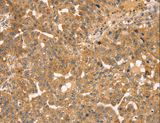 STX10 / Syntaxin 10 Antibody - Immunohistochemistry of paraffin-embedded Human breast cancer using STX10 Polyclonal Antibody at dilution of 1:35.