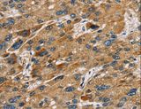 SULT1B1 / Sulfotransferase 1B1 Antibody - Immunohistochemistry of paraffin-embedded Human liver cancer using SULT1B1 Polyclonal Antibody at dilution of 1:30.