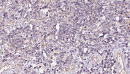SULT1C2 / Sulfotransferase 1C2 Antibody - 1:100 staining human lymph carcinoma tissue by IHC-P. The sample was formaldehyde fixed and a heat mediated antigen retrieval step in citrate buffer was performed. The sample was then blocked and incubated with the antibody for 1.5 hours at 22°C. An HRP conjugated goat anti-rabbit antibody was used as the secondary.