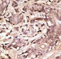SUMO4 Antibody - Formalin-fixed and paraffin-embedded human cancer tissue reacted with the primary antibody, which was peroxidase-conjugated to the secondary antibody, followed by AEC staining. This data demonstrates the use of this antibody for immunohistochemistry; clinical relevance has not been evaluated. BC = breast carcinoma; HC = hepatocarcinoma.