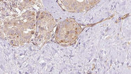 SUOX / Sulfite Oxidase Antibody - 1:100 staining human thyroid carcinoma tissue by IHC-P. The sample was formaldehyde fixed and a heat mediated antigen retrieval step in citrate buffer was performed. The sample was then blocked and incubated with the antibody for 1.5 hours at 22°C. An HRP conjugated goat anti-rabbit antibody was used as the secondary.