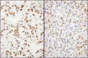 SUPT6H / SPT6 Antibody - Detection of Human and Mouse SUPT6H by Immunohistochemistry. Sample: FFPE sections of human breast carcinoma (left) and mouse squamous cell carcinoma (right). Antibody: Affinity purified rabbit anti-SUPT6H used at a dilution of 1:200 (1 ug/ml). Detection: DAB.