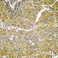 SVOP Antibody - Immunohistochemical analysis of SVOP staining in human liver cancer formalin fixed paraffin embedded tissue section. The section was pre-treated using heat mediated antigen retrieval with sodium citrate buffer (pH 6.0). The section was then incubated with the antibody at room temperature and detected with HRP and DAB as chromogen. The section was then counterstained with hematoxylin and mounted with DPX.