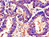 SWI5 / C9orf119 Antibody - Immunohistochemistry of paraffin-embedded human colon cancer using SWI5 Antibody at dilution of 1:100