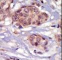 SYN / FYN Antibody - Formalin-fixed and paraffin-embedded human cancer tissue reacted with the primary antibody, which was peroxidase-conjugated to the secondary antibody, followed by DAB staining. This data demonstrates the use of this antibody for immunohistochemistry; clinical relevance has not been evaluated. BC = breast carcinoma; HC = hepatocarcinoma.