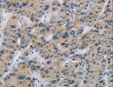 SYN2 / Synapsin II Antibody - Immunohistochemistry of paraffin-embedded Human liver cancer using SYN2 Polyclonal Antibody at dilution of 1:40.