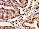 Synaptic nuclei expressed gene 2 (SYNE-2) Antibody - Immunohistochemistry image of paraffin-embedded human endometrial cancer at a dilution of 1:100