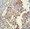 SYNCAM / CADM1 Antibody - CADM1 antibody immunohistochemistry of formalin-fixed and paraffin-embedded human lung carcinoma followed by peroxidase-conjugated secondary antibody and DAB staining.