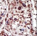 Syndapin I / PACSIN1 Antibody - Formalin-fixed and paraffin-embedded human cancer tissue reacted with the primary antibody, which was peroxidase-conjugated to the secondary antibody, followed by DAB staining. This data demonstrates the use of this antibody for immunohistochemistry; clinical relevance has not been evaluated. BC = breast carcinoma; HC = hepatocarcinoma.