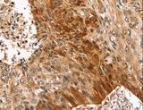 SYNPO2 / Synaptopodin 2 Antibody - Immunohistochemistry of paraffin-embedded Human esophagus cancer using SYNPO2 Polyclonal Antibody at dilution of 1:50.