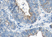 SYT1 / Synaptotagmin Antibody - 1:100 staining human Thyroid carcinoma tissue by IHC-P. The tissue was formaldehyde fixed and a heat mediated antigen retrieval step in citrate buffer was performed. The tissue was then blocked and incubated with the antibody for 1.5 hours at 22°C. An HRP conjugated goat anti-rabbit antibody was used as the secondary.