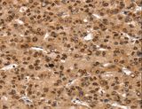 TAF10 Antibody - Immunohistochemistry of paraffin-embedded Human liver cancer using TAF10 Polyclonal Antibody at dilution of 1:35.
