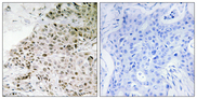 TAF13 Antibody - Immunohistochemistry analysis of paraffin-embedded human breast carcinoma tissue, using TAF13 Antibody. The picture on the right is blocked with the synthesized peptide.
