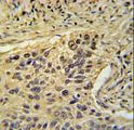 TAF2 Antibody - TAF2 Antibody immunohistochemistry of formalin-fixed and paraffin-embedded human lung carcinoma followed by peroxidase-conjugated secondary antibody and DAB staining.