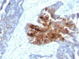 TAG-72 Antibody - IHC staining of human ovarian carcinoma with TAG-72 antibody cocktail (B72.3 + CA72/733).