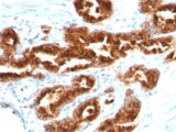 TAG-72 Antibody - IHC staining of human prostate carcinoma with TAG-72 antibody