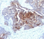 TAG-72 Antibody - IHC testing of human ovarian carcinoma with TAG-72 antibody.