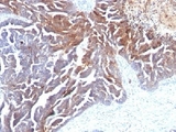 TAG-72 Antibody - Formalin-fixed, paraffin-embedded human ovarian carcinoma stained with TAG-72 antibody (B72.3 + CC49).  This image was taken for the unmodified form of this product. Other forms have not been tested.
