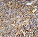 TANK Antibody - TANK Antibody immunohistochemistry of formalin-fixed and paraffin-embedded human cervix carcinoma followed by peroxidase-conjugated secondary antibody and DAB staining.
