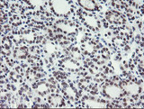 TASP / LANCL2 Antibody - IHC of paraffin-embedded Carcinoma of Human thyroid tissue using anti-LANCL2 mouse monoclonal antibody.