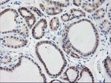 TBC1D21 Antibody - IHC of paraffin-embedded Carcinoma of Human thyroid tissue using anti-TBC1D21 mouse monoclonal antibody. (Heat-induced epitope retrieval by 10mM citric buffer, pH6.0, 100C for 10min).