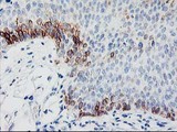 TBC1D21 Antibody - IHC of paraffin-embedded Carcinoma of Human bladder tissue using anti-TBC1D21 mouse monoclonal antibody.