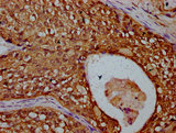 TBCD Antibody - Immunohistochemistry Dilution at 1:300 and staining in paraffin-embedded human cervical cancer performed on a Leica BondTM system. After dewaxing and hydration, antigen retrieval was mediated by high pressure in a citrate buffer (pH 6.0). Section was blocked with 10% normal Goat serum 30min at RT. Then primary antibody (1% BSA) was incubated at 4°C overnight. The primary is detected by a biotinylated Secondary antibody and visualized using an HRP conjugated SP system.