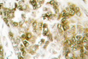 TBX15+18 Antibody - IHC of TBX15/18 (D164) pAb in paraffin-embedded human breast carcinoma tissue.