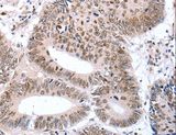 TBX2 Antibody - Immunohistochemistry of paraffin-embedded Human colon cancer using TBX2 Polyclonal Antibody at dilution of 1:32.
