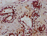 TCEA3 Antibody - Immunohistochemistry Dilution at 1:600 and staining in paraffin-embedded human breast cancer performed on a Leica BondTM system. After dewaxing and hydration, antigen retrieval was mediated by high pressure in a citrate buffer (pH 6.0). Section was blocked with 10% normal Goat serum 30min at RT. Then primary antibody (1% BSA) was incubated at 4°C overnight. The primary is detected by a biotinylated Secondary antibody and visualized using an HRP conjugated SP system.