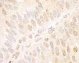 TCF12 / HEB Antibody - Detection of Human TCF12 by Immunohistochemistry. Sample: FFPE section of human breast carcinoma. Antibody: Affinity purified rabbit anti-TCF12 used at a dilution of 1:1000 (1 ug/ml). Detection: DAB.