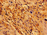TCF15 / PARAXIS Antibody - Immunohistochemistry image of paraffin-embedded human cervical cancer at a dilution of 1:100