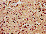 TCF20 Antibody - Immunohistochemistry Dilution at 1:300 and staining in paraffin-embedded human glioma cancer performed on a Leica BondTM system. After dewaxing and hydration, antigen retrieval was mediated by high pressure in a citrate buffer (pH 6.0). Section was blocked with 10% normal Goat serum 30min at RT. Then primary antibody (1% BSA) was incubated at 4°C overnight. The primary is detected by a biotinylated Secondary antibody and visualized using an HRP conjugated SP system.