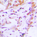 TCF7 Antibody - Immunohistochemical analysis of TCF7 staining in human breast cancer formalin fixed paraffin embedded tissue section. The section was pre-treated using heat mediated antigen retrieval with sodium citrate buffer (pH 6.0). The section was then incubated with the antibody at room temperature and detected using an HRP conjugated compact polymer system. DAB was used as the chromogen. The section was then counterstained with hematoxylin and mounted with DPX.
