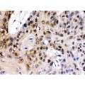 TCF7L1 / TCF-3 Antibody - TCF7L1 was detected in paraffin-embedded sections of human esophagus squama cancer tissues using rabbit anti- TCF7L1 Antigen Affinity purified polyclonal antibody at 1 ug/mL. The immunohistochemical section was developed using SABC method.