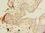 TCP11L2 Antibody - Immunohistochemistry of paraffin-embedded human breast cancer using antibody at dilution of 1:100.