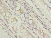 TCTA Antibody - Immunohistochemistry of paraffin-embedded human colon cancer using antibody at dilution of 1:100.