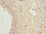 TCTEX1D2 Antibody - Immunohistochemistry of paraffin-embedded human ovarian cancer using antibody at dilution of 1:100.