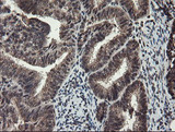 TDO2 Antibody - IHC of paraffin-embedded Adenocarcinoma of Human endometrium tissue using anti-TDO2 mouse monoclonal antibody.