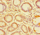 TDRD1 Antibody - Immunohistochemistry of paraffin-embedded human gastric cancer at dilution of 1:100