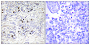 TEAD2 Antibody - Immunohistochemistry analysis of paraffin-embedded human breast carcinoma tissue, using TEAD2 Antibody. The picture on the right is blocked with the synthesized peptide.