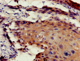 TEL-2 / ETV7 Antibody - Immunohistochemistry of paraffin-embedded human cervical cancer at dilution of 1:100